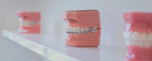 Model eines Gebisses mit Zahnspange