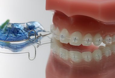 Lose und feste Zahnspange im Vergleich