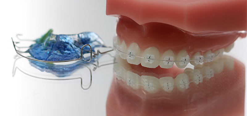 Lose und feste Zahnspange im Vergleich