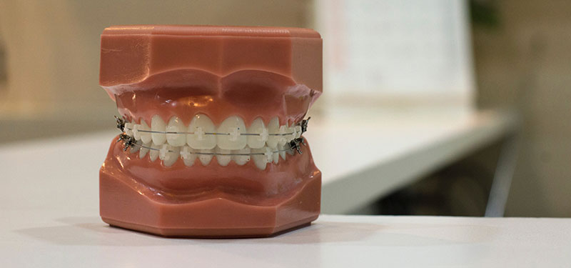 Zahnspangenmodell