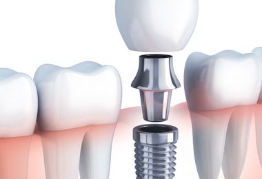 Implantat Illustration