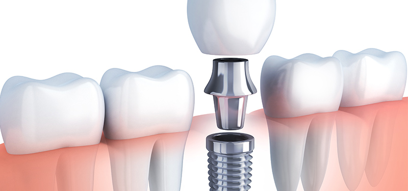 Implantat Illustration