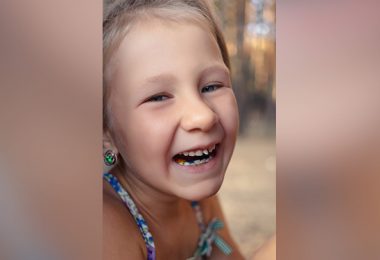 kleines Mädchen mit Zahnschiefstand