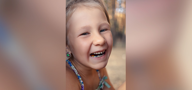 kleines Mädchen mit Zahnschiefstand