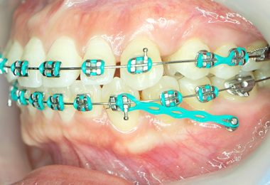 Mini-Implantate und Zahnspange
