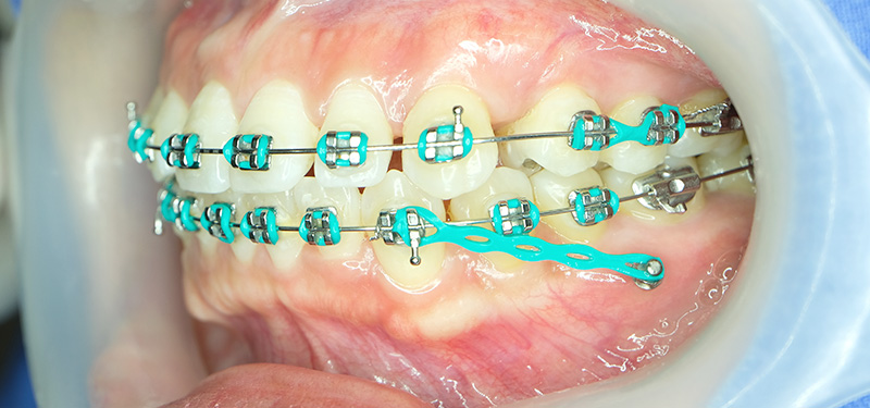 Mini-Implantate und Zahnspange